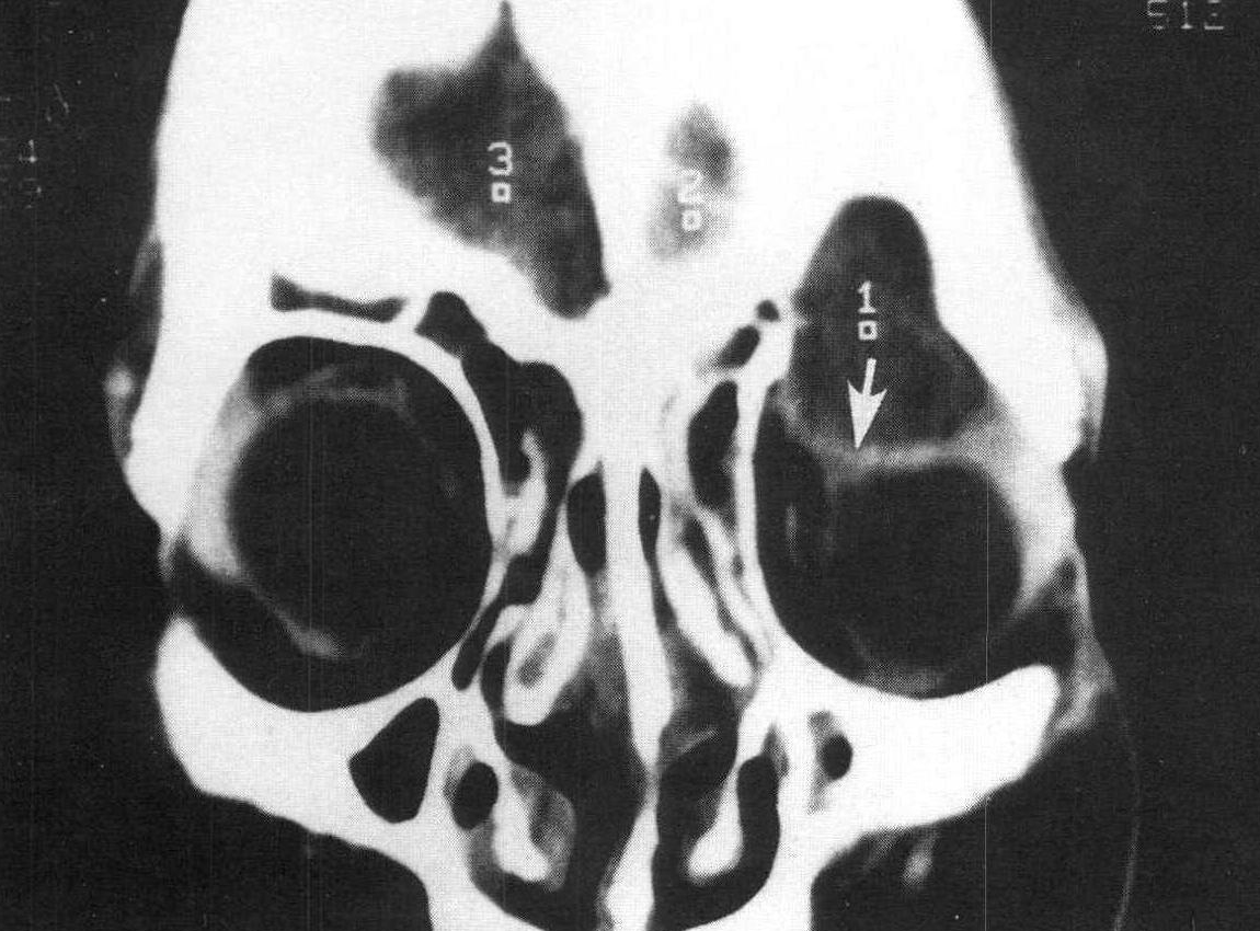 鼻旁窦的 X 射线图像用于诊断鼻窦炎。高清摄影大图-千库网